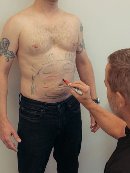 Male Liposuction - The Gentle Sculpt Advantage for Men