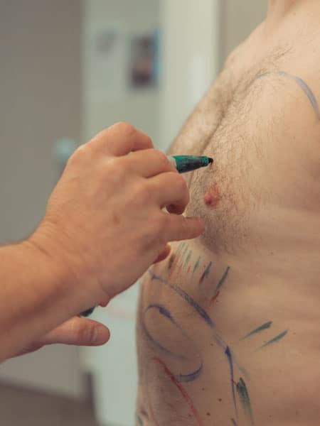 Male Liposuction - Patient Consultation with Dr. Hall