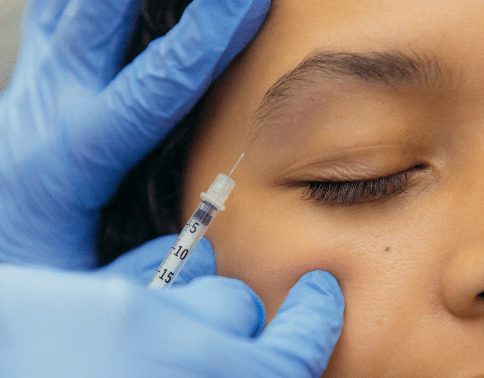 FILLER + FREE BOTOX