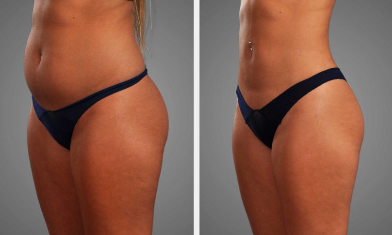 Before and after