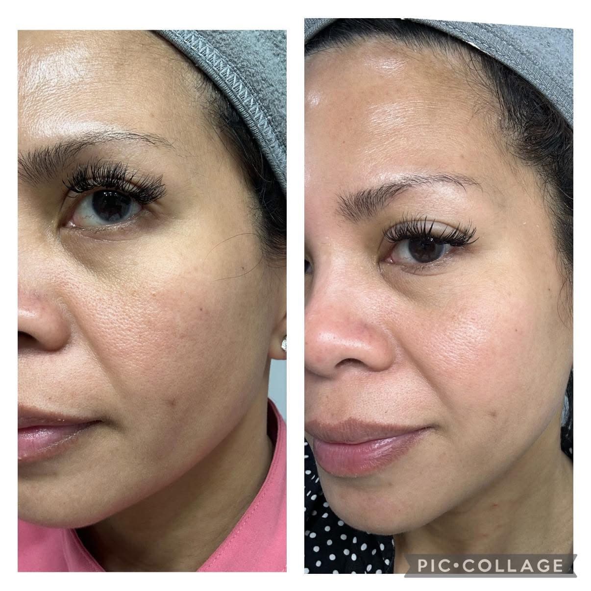 Área de ojos de cliente femenina antes y después mostrando reducción de líneas finas