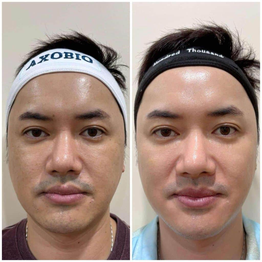 Cliente masculino antes y después mostrando poros refinados y tono uniforme