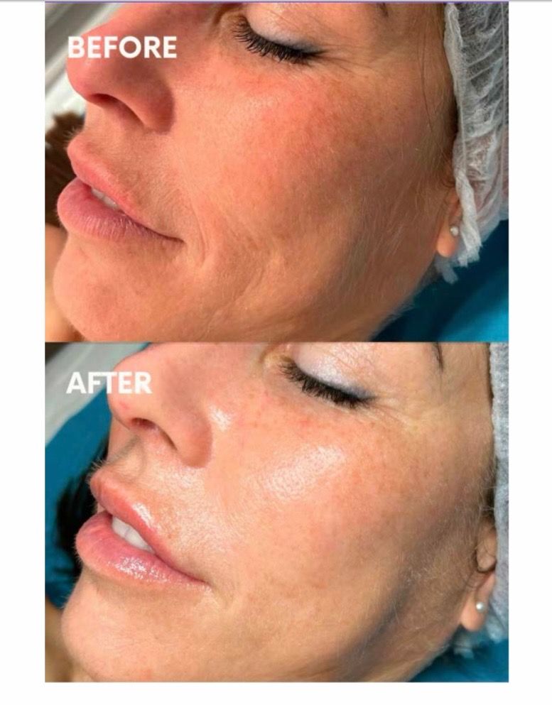 Antes y después de terapia con ADN de salmón mostrando textura e hidratación mejoradas